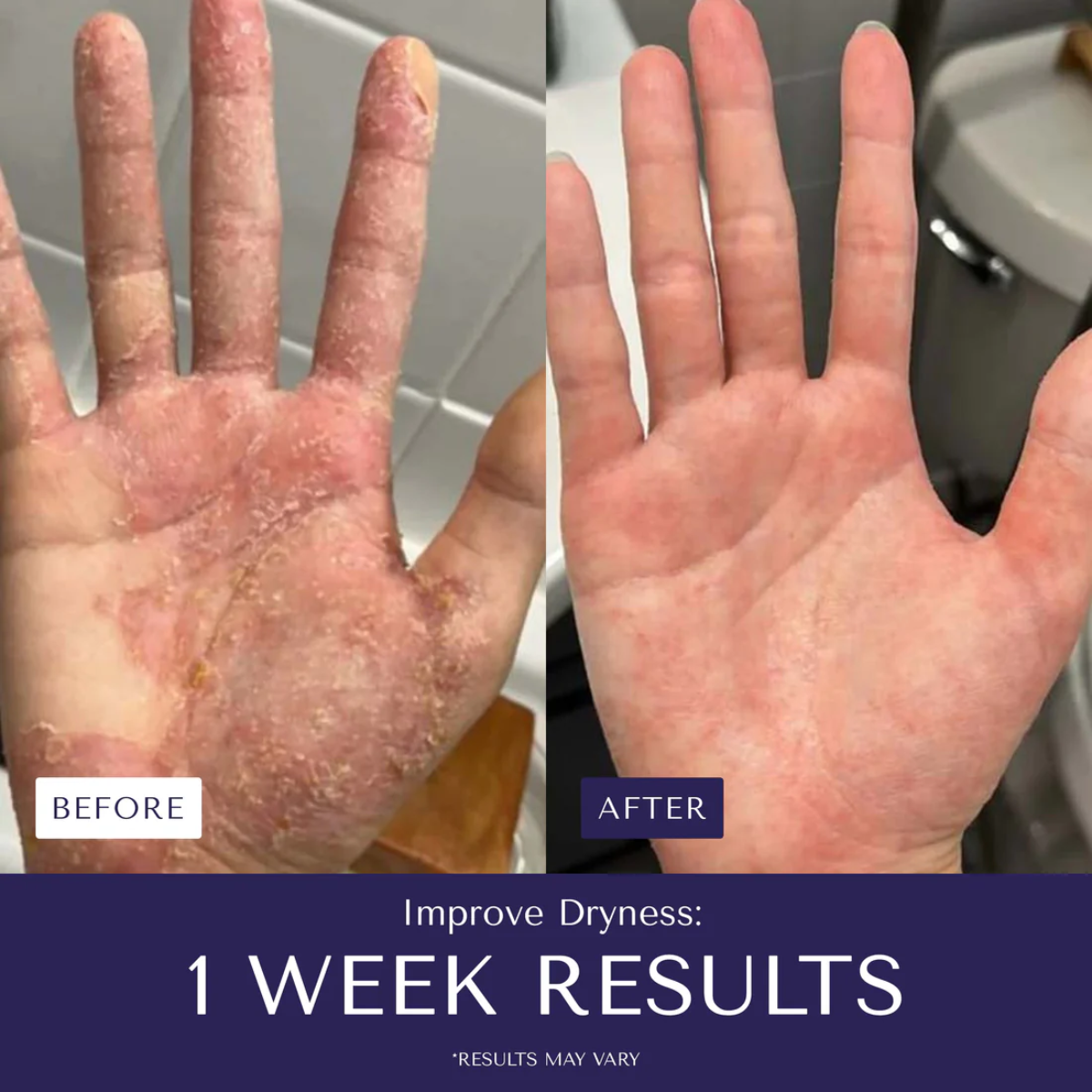 Eczema™ - Stop suffering from irritations or burns