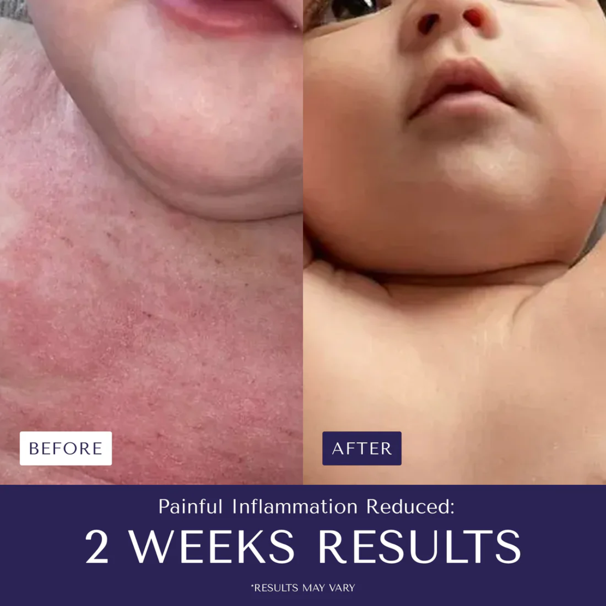 Eczema™ - Stop suffering from irritations or burns