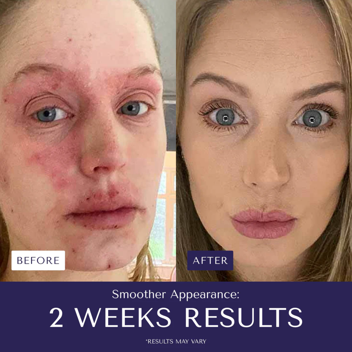 Eczema™ - Stop suffering from irritations or burns